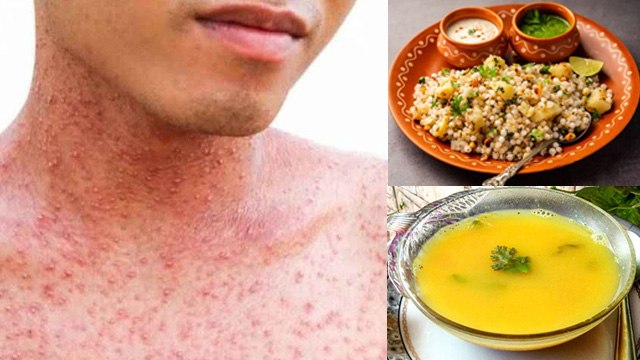 Khasra Mei Kya Khana Chahie Kya Nahin| Diet For Measles Patients In Hindi | Boldsky