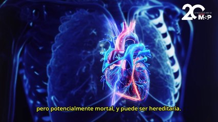 ¿Qué es el síndrome de Brugada y cómo actúa? - #EspecialMSP