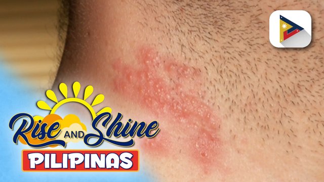 SAY ni DOK | Alamin ang mga karaniwang sakit sa balat na nauuso tuwing tag-init!