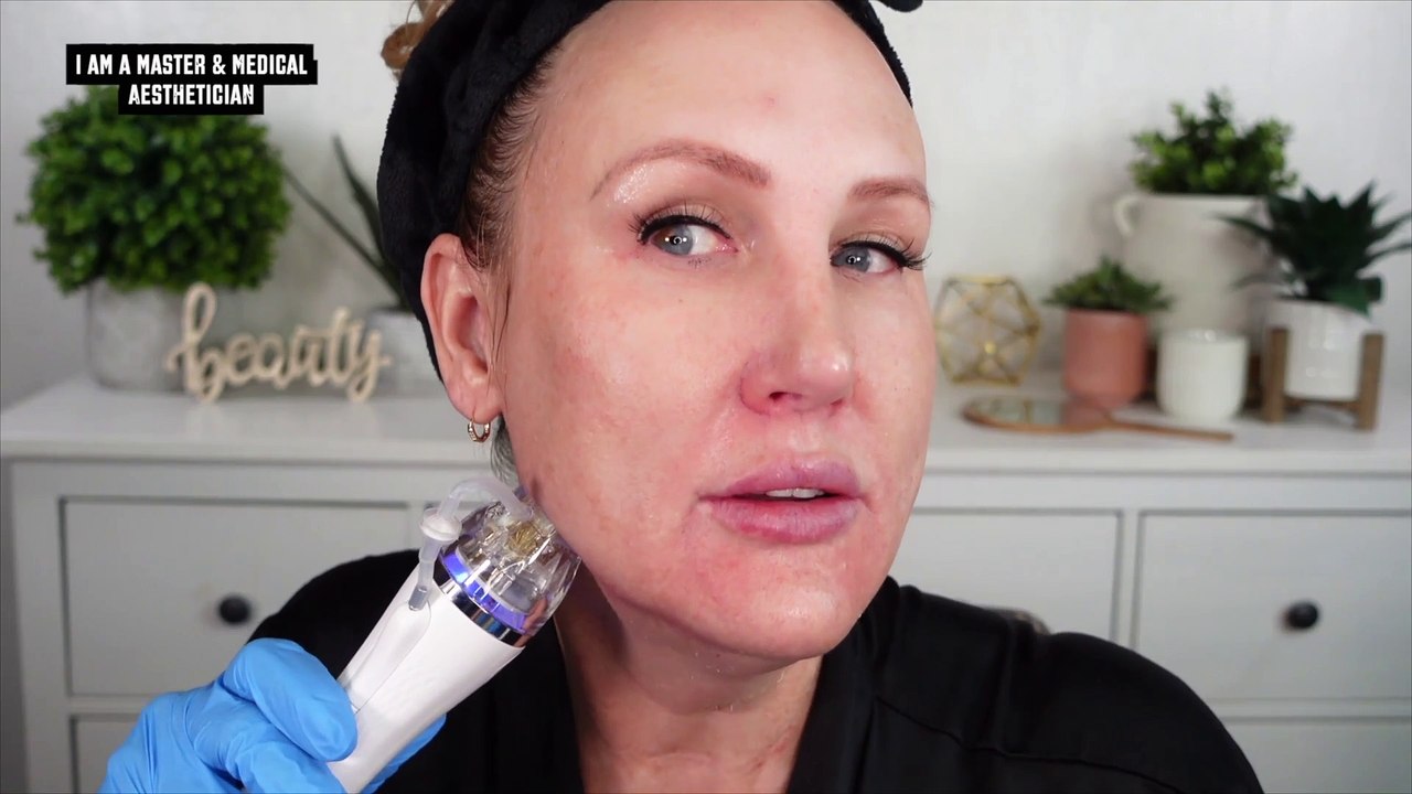 Microneedling Tutorial Session 1