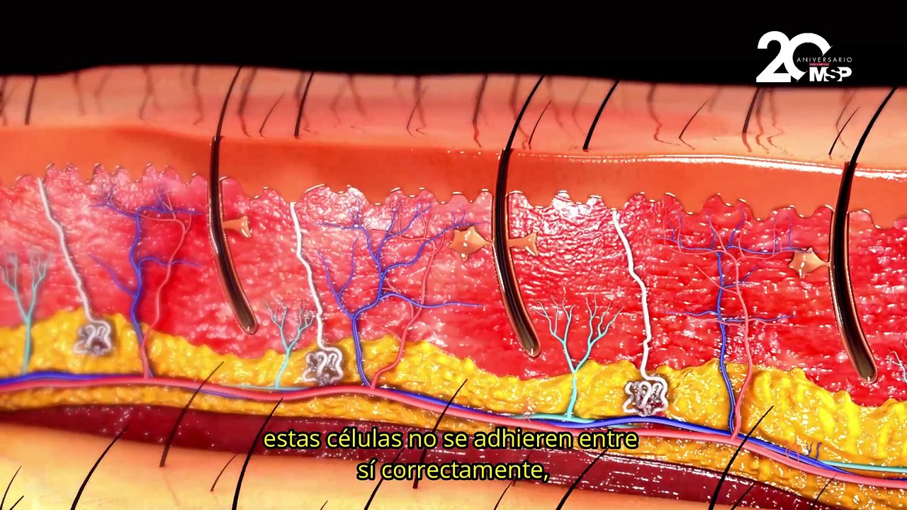 Dermatitis atópica y un viaje al interior de la piel inflamada - #ExclusivoMSP