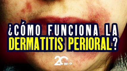 ¿Cómo funciona la dermatitis perioral? - #EspecialMSP