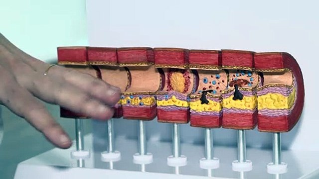 Una mujer muere cada 6 minutos en Europa por enfermedad cardiovascular y el 80% se puede evitar