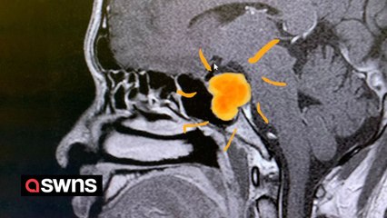 "I thought my double vision was caused by looking at my screen for too long - but it was rare bone cancer"