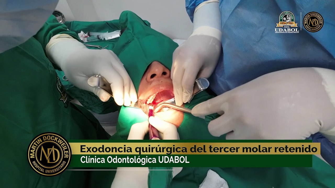 Intervención del Tercer Molar Retenido