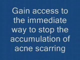 The Best Way To Remove Acne, Pimple and Zits