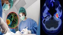 Mesenchymal Tumor क्या है | 39 Year Old Men की After 15 Year Brain Tumor Surgery Successful |Boldsky