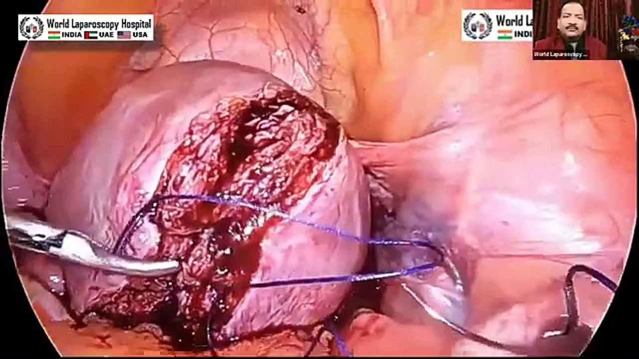 Advancing Surgical Precision Key Insights into Laparoscopic Myomectomy - Dr. R.K. Mishra