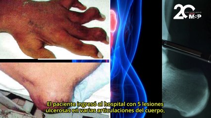 Hombre desarrolló insuficiencia renal crónica por gota no tratada - #ExclusivoMSP