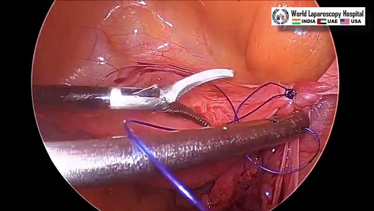 Laparoscopic Uterine suspension for treating chronic pelvic pain caused by uterine retroversion