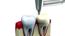 Crowning Glory: A Guide to Dental Crowns