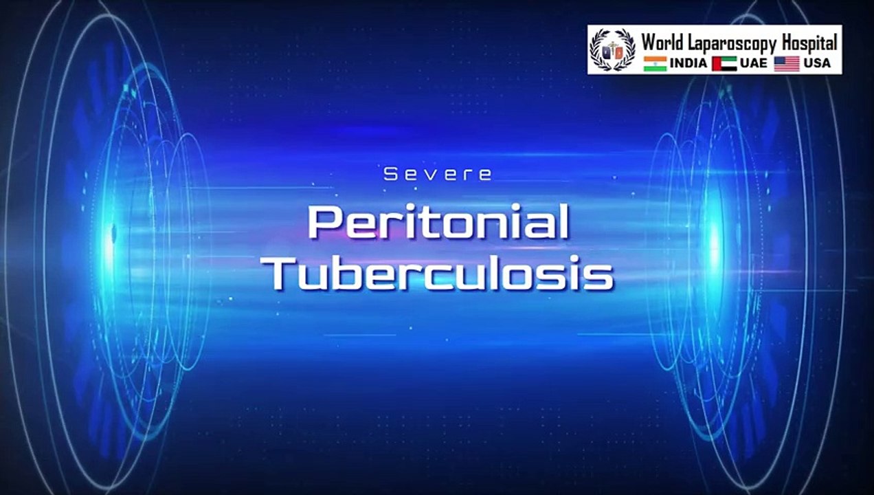 Laparoscopy in Peritoneal Tuberculosis A Revolutionary Diagnostic and Therapeutic Approach