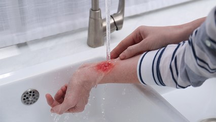 bd-consejos-para-atender-una-quemadura-en-casa-080324