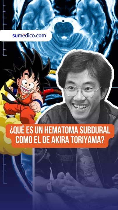 ¿Qué es un hematoma subdural como el que causó la muerte de Akira Toriyama, creador de Dragon Ball?.