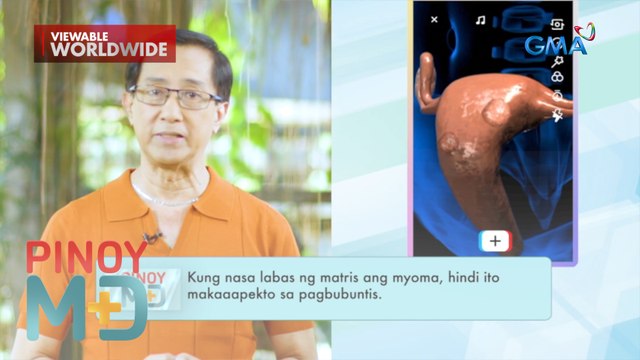 Babaeng may myoma sa matres, posible pa bang mabuntis? | Pinoy MD