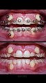 braces time lapse 