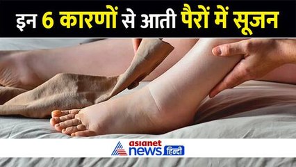 डॉक्टर ने बताया- 6 कारणों से आती है पैरों में सूजन