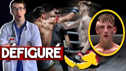 SON VISAGE VA EXPLOSER : LA BLESSURE LA PLUS IMPRESSIONNANTE DU MMA