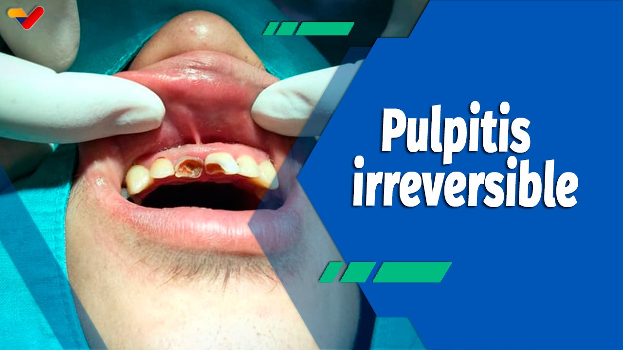 Actitud Saludable | Pulpitis irreversible, causas y tratamientos ...