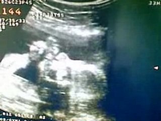 Crevette : echographie du 5e mois