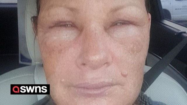 Woman suffers burns when her pressure cooker exploded while cooking soup