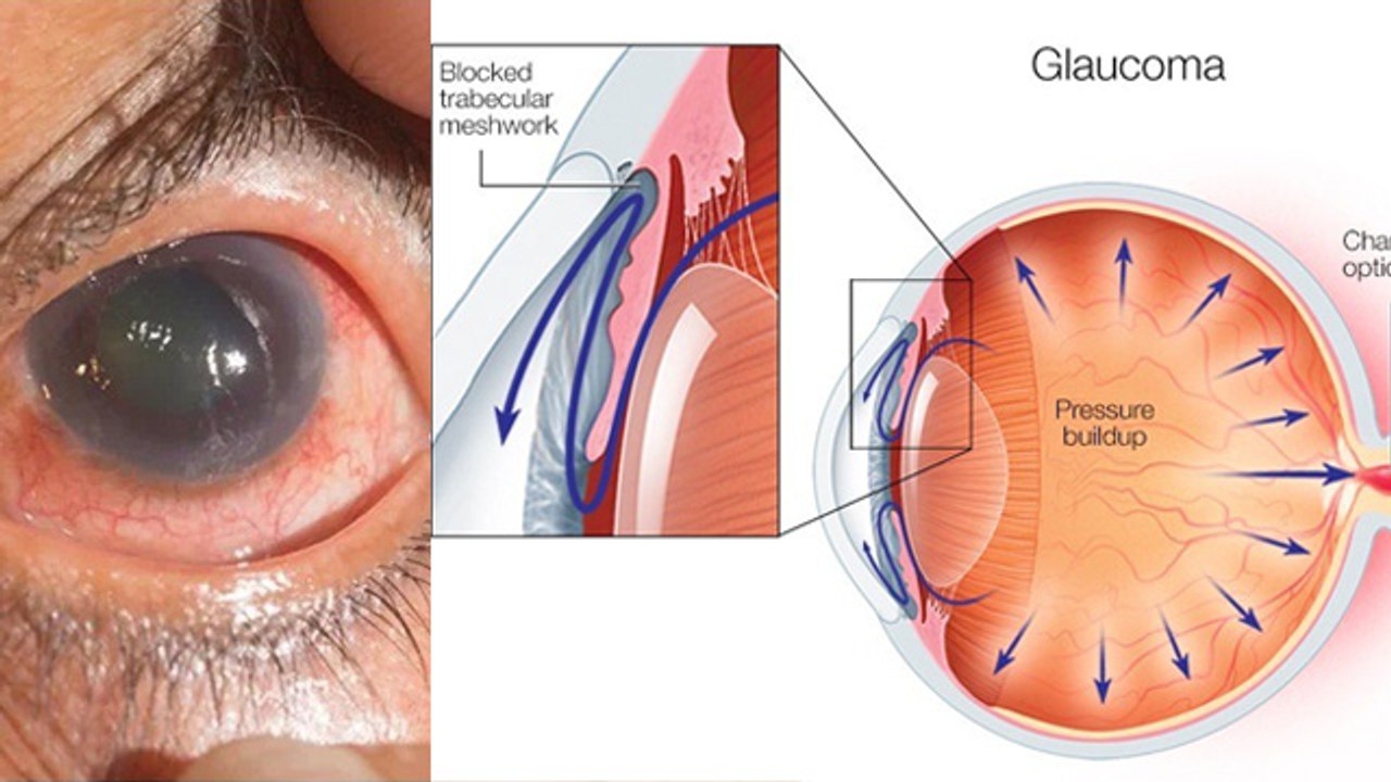 ग्लूकोमा क्या होता है |Glucoma Kyu Hota Hai, Symptoms & Treatment In Hindi|Boldsky