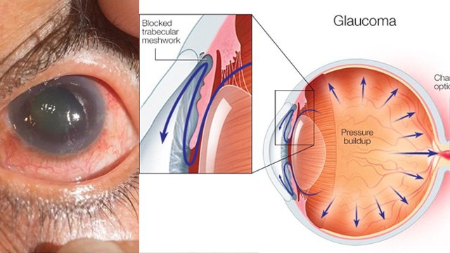 ग्लूकोमा क्या होता है |Glucoma Kyu Hota Hai, Symptoms & Treatment In Hindi|Boldsky