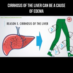 Cirrhosis of the liver can be a cause of edema