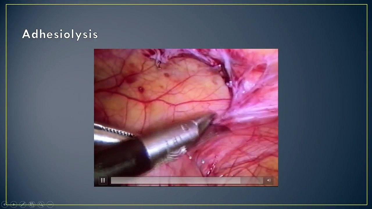 Adhesiolysis and Adhesion Prevension