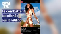Ni grave, ni contagieux, ils combattent les clichés sur le vitiligo sur les réseaux sociaux