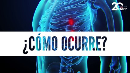 Fractura costal: ¿Qué pasa cuando se lastima un pulmón? - #EspecialMSP