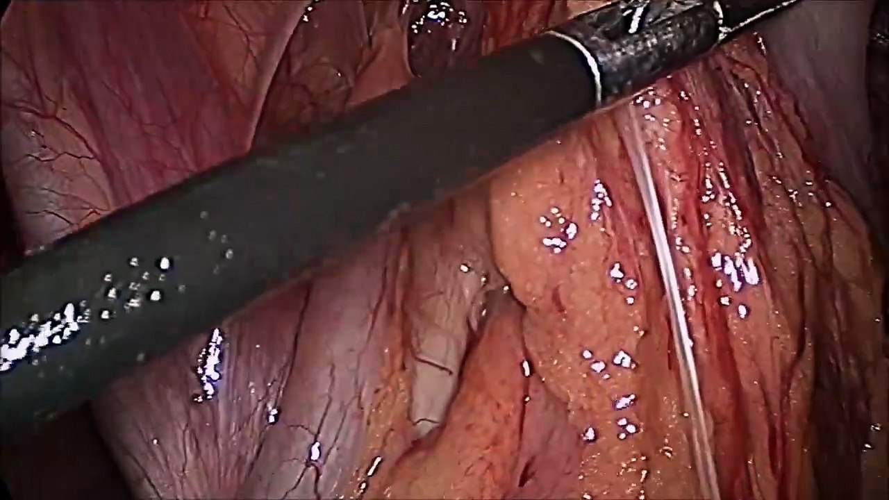 Appendectomy for Acute Appendicitis by Mishra's Knot