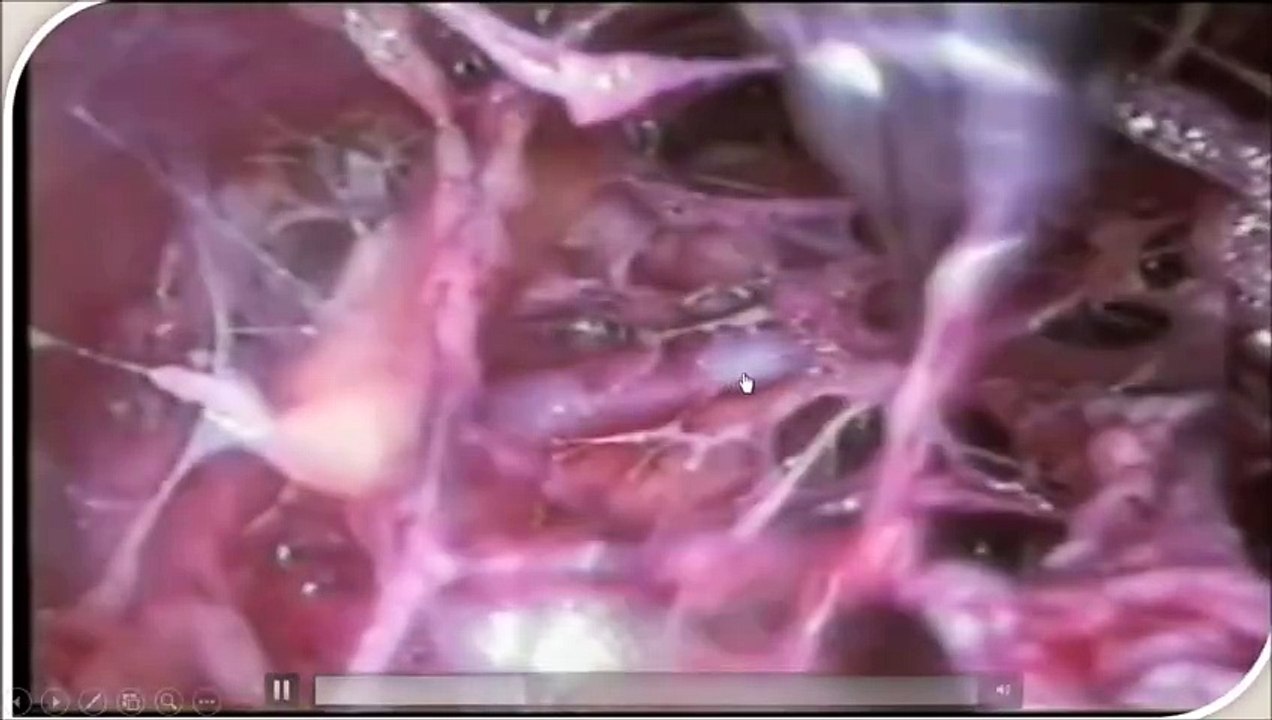 Axillary Lymph Node Resection and Thyroidectomy - Lecture by Dr R K Mishra