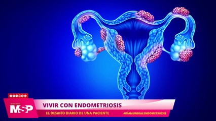 Vivir con endometriosis: El desafío diario de una paciente con Vanessa Marzán - #ExclusivoMSP