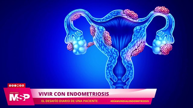 Vivir con endometriosis: El desafío diario de una paciente con Vanessa Marzán - #ExclusivoMSP