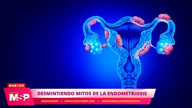 Desmintiendo mitos de la endometriosis con el Dr. Juan Diego Villegas - #ExclusivoMSP
