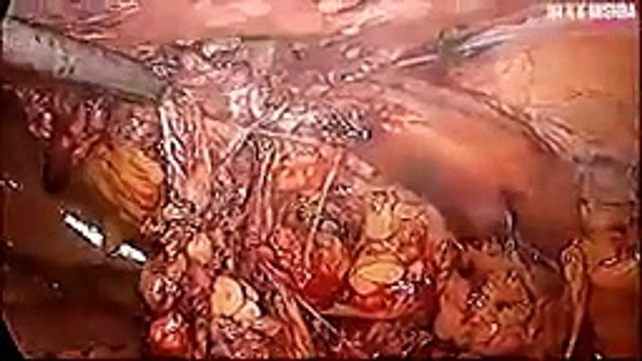Laparoscopic Repair of Incisional Hernia by Two Ports