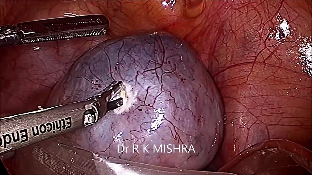 Bilateral Dermoid Cyst