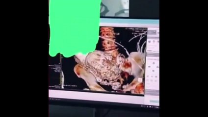 Milagre ou maldição? Feto calcificado é encontrado em idosa após 50 anos