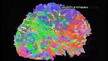 Nueva resonancia magnética revela los misterios de Lesiones Cerebrales