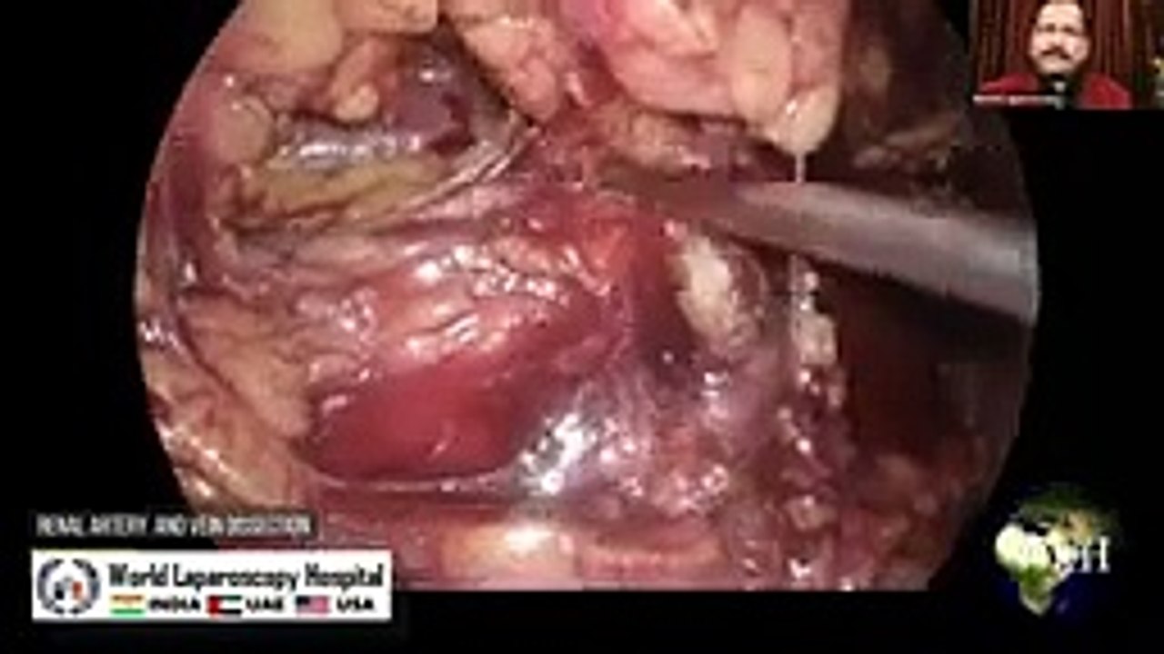 Mastering Laparoscopic Nephrectomy_ Techniques, Challenges, and Innovations - Dr. R.K. Mishra