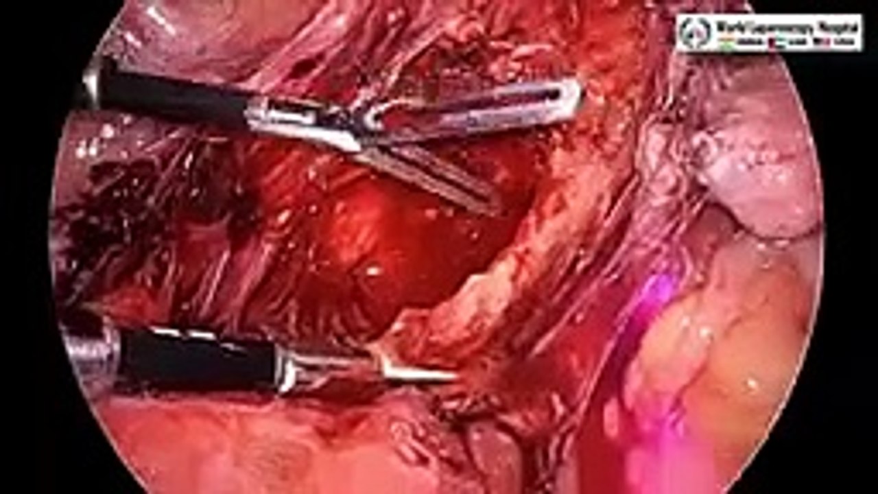 Mastering TLH Complexity_ Total Laparoscopic Hysterectomy for Densely Adhered Urinary Bladder