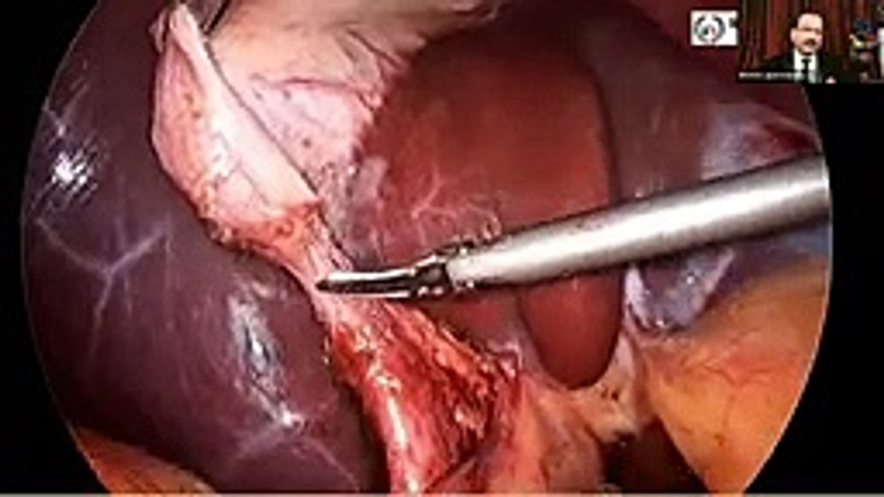 Excelling Laparoscopic Cholecystectomy Surgery - Dr. R.K. Mishra