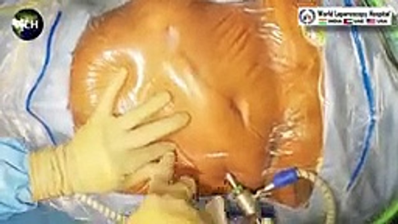 Laparoscopic Incisional Hernia Repair_ Step-by-Step Surgical Guide By Dr. R.K. Mishra