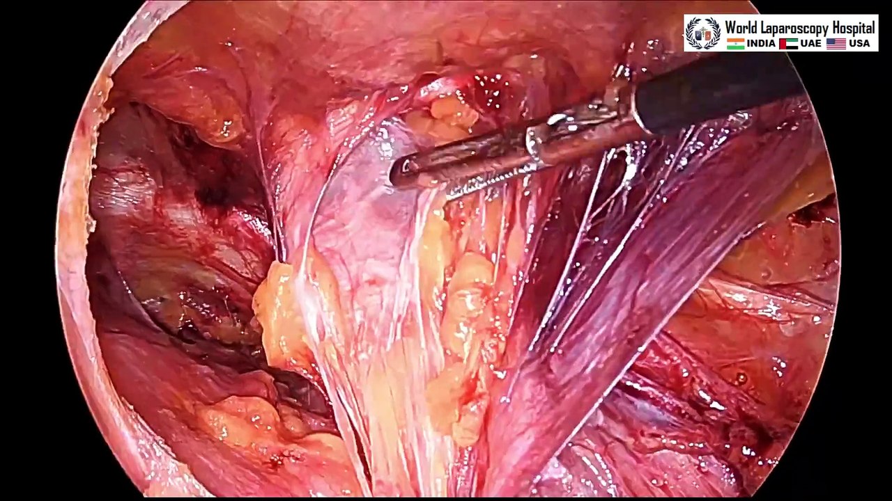 Bilateral Inguinal Hernia Laparoscopic TAPP Repair