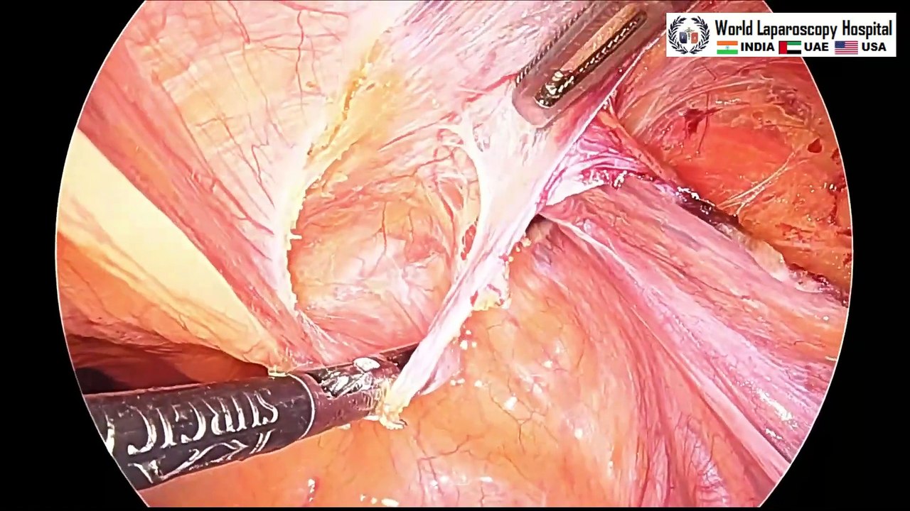 Bilateral Inguinal Hernia Surgery Trans Abdominal Preperitoneal Repair