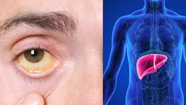 Bilirubin Normal Range | High Bilirubin levels Treatment , Causes, Symptoms In Hindi | Boldsky