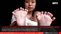 Niño nacido en China con 15 dedos en la mano y 16 en los pies