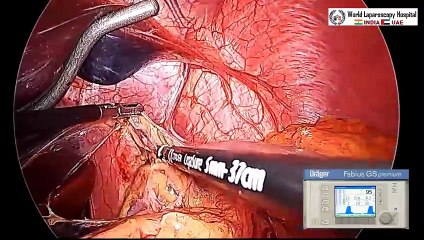 Laparoscopic Heller's Myotomy with Appendectomy