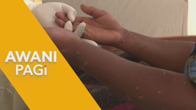 AWANI Pagi: Memahami vaksinasi Mpox